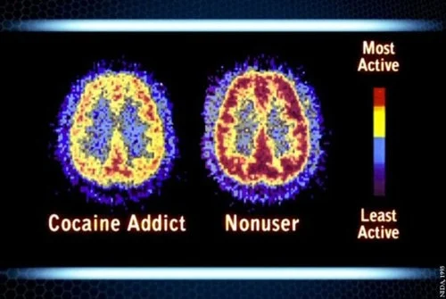 effects-of-substance-abuse-on-young-brains